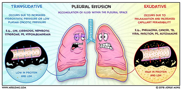 efusi-pleura-indonesia-re